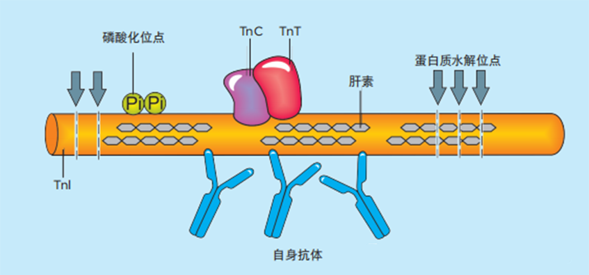 心辜运梗患者血液中的 cTnI分子片段